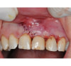 Chirurgie buccale et parodontale