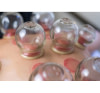 La thérapie par Ventouse ou << Cupping >>