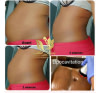 Lipocavitation