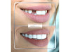 Implants dentaires