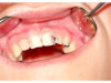 Traitement de caries
