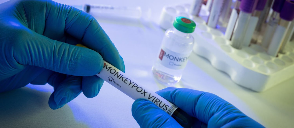 variole du singe en Côte d 'Ivoire