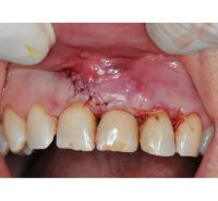 Chirurgie buccale et parodontale