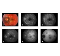 Angio fluorographie rétinographie oculaire
