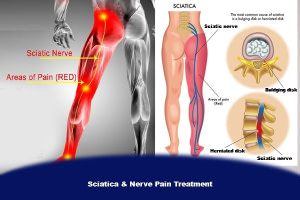 Joint, Sciatica & Nerve Pain Center