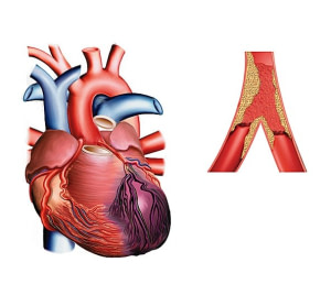 Maladies du cœur et des vaisseaux